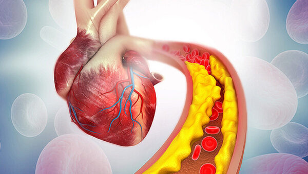 علائم هشدار دهنده کلسترول بالا در بدن