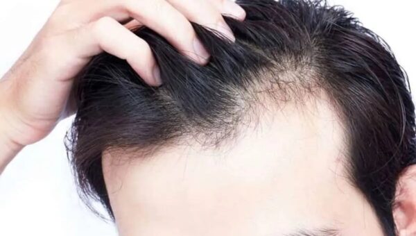با چند خوراکی ساده از موها مراقبت کنیم